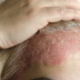 The Link Between Psoriasis and Other Health Conditions
